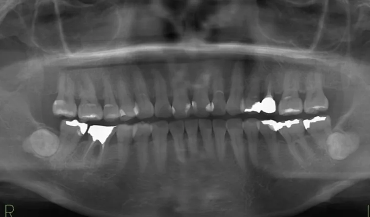 日本歯科グループの症例写真・治療前