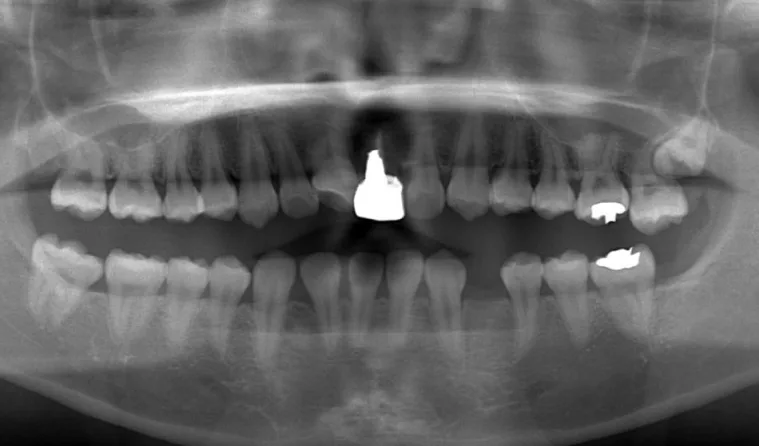 日本歯科グループの症例写真・治療前