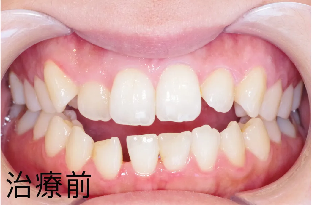 日本歯科グループの症例写真・治療前