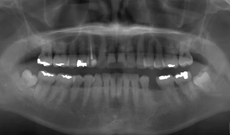 日本歯科グループの症例写真・治療前