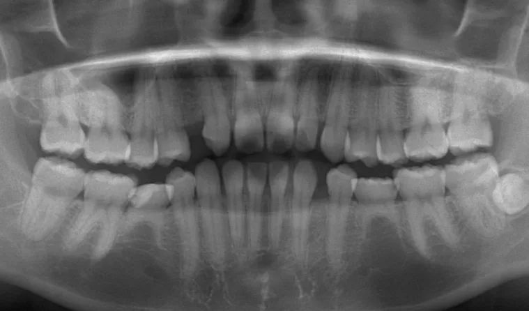 日本歯科グループの症例写真・治療前