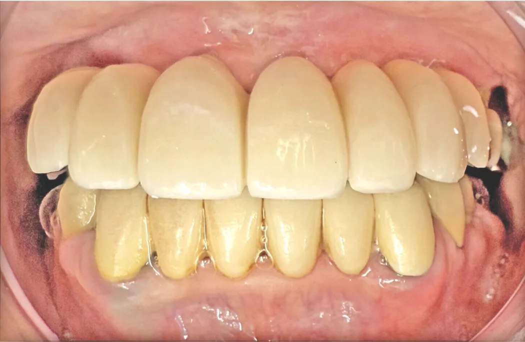 日本歯科グループの症例写真・治療後