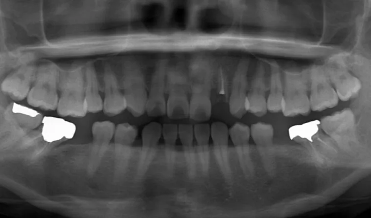 日本歯科グループの症例写真・治療前